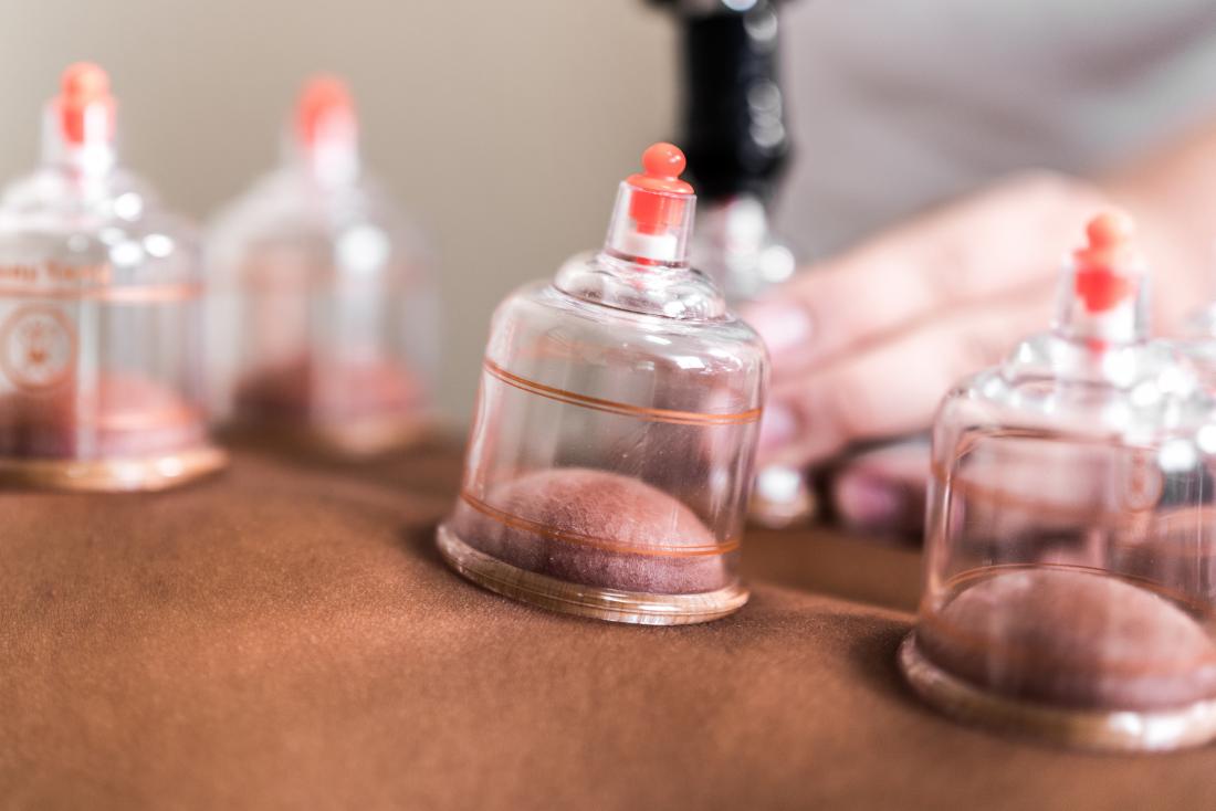 Person having cupping therapy close up view of skin on back suctioned in cup.