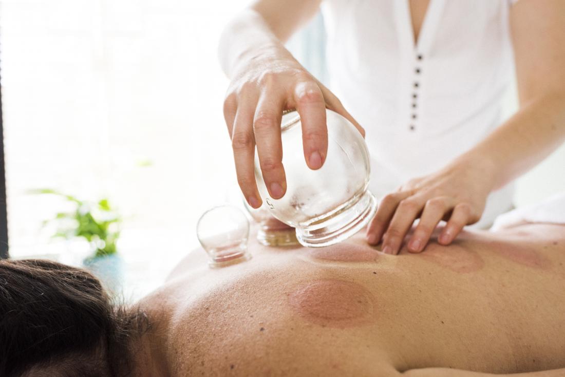 Person having cupping therapy applied to back.