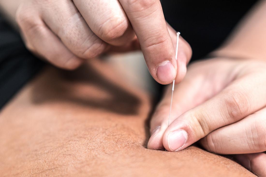 man having acupuncture for psoriasis