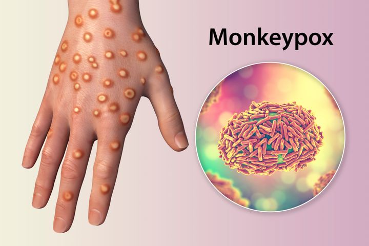 Hand of a patient with monkeypox infection and close-up view of monkeypox virus particles, computer illustration