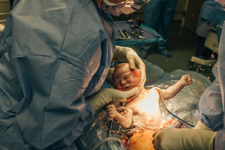 Doctors work to remove a baby from a woman's uterus during a c section.