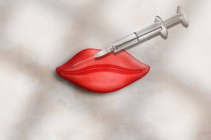 “Filled lips are easier to spot [than other injectables], as it is common for the cupid’s bow to flatten out when the upper lip is filled,” Sominsky said.