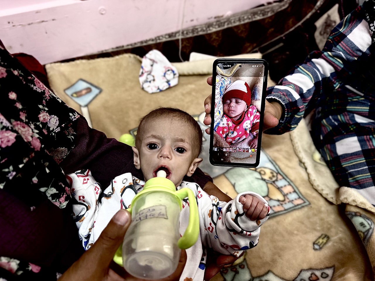 Suwar Ashur, 5 months, is being treated for malnutrition at Nasser Hospital in Khan Younis, Gaza, on May 1. Suwar is one of thousands of children experiencing malnutrition as a result of Israel's total blockade of food and humanitarian assistance.