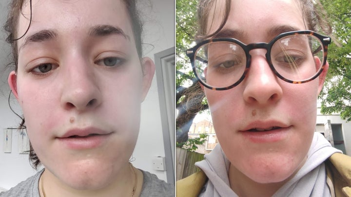 The post-workout redness that made me think, "when is this worth worrying about?"