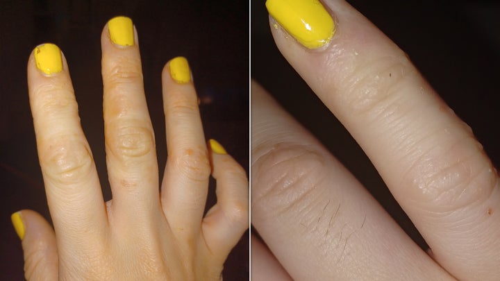 Disyhdrotic eczema