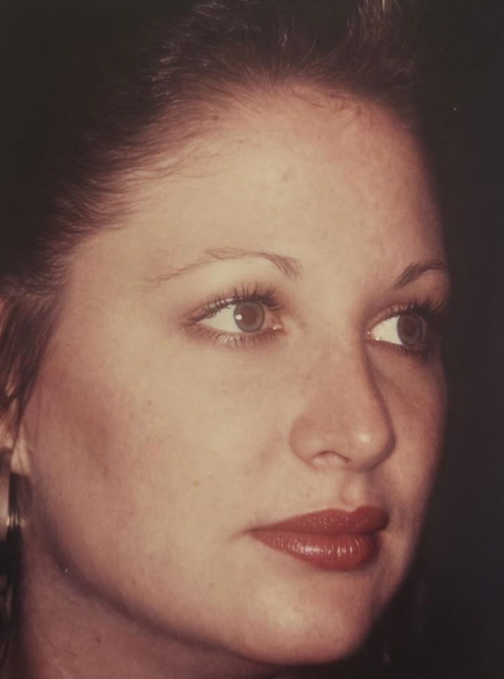 "This is me in my early 20s, shortly after my nose surgery," the author writes. "The photo was taken by my doctor."